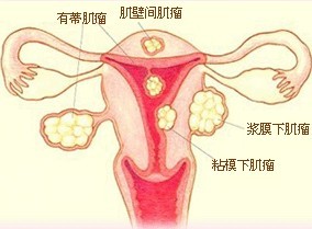 子宫肌瘤导致不孕
