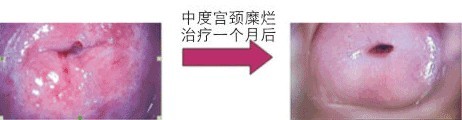 中度宫颈糜烂治疗前后