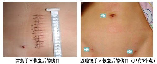 腹腔镜技术微创效果 腹腔镜技术微创效果