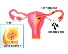 子宫内膜异位症