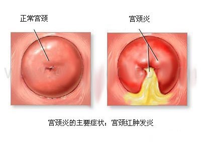 宫颈炎的表现